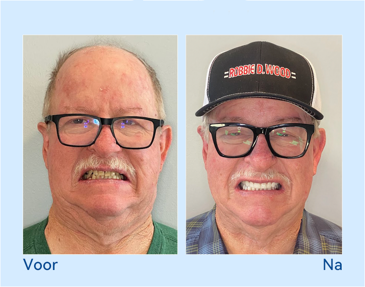 𝐇𝐢𝐝𝐨𝐧𝐞® --🦷𝐆𝐞𝐚𝐯𝐚𝐧𝐜𝐞𝐞𝐫𝐝 𝐀𝐚𝐧𝐠𝐞𝐩𝐚𝐬𝐭 𝐕𝐨𝐥𝐥𝐞𝐝𝐢𝐠𝐞 𝐊𝐮𝐧𝐬𝐭𝐠𝐞𝐛𝐢𝐭𝐬𝐞𝐭🦷 (⏰Tijdelijke korting, laatste 30 minuten⏰)📗📗