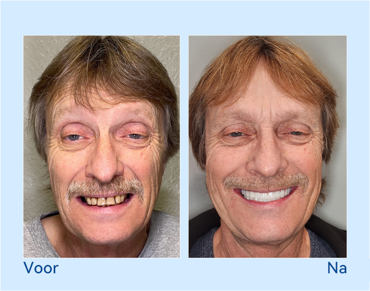 𝐇𝐢𝐝𝐨𝐧𝐞® --🦷𝐆𝐞𝐚𝐯𝐚𝐧𝐜𝐞𝐞𝐫𝐝 𝐀𝐚𝐧𝐠𝐞𝐩𝐚𝐬𝐭 𝐕𝐨𝐥𝐥𝐞𝐝𝐢𝐠𝐞 𝐊𝐮𝐧𝐬𝐭𝐠𝐞𝐛𝐢𝐭𝐬𝐞𝐭🦷 (⏰Tijdelijke korting, laatste 30 minuten⏰)📗📗