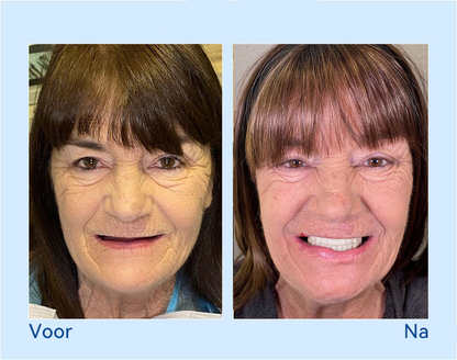 𝐇𝐢𝐝𝐨𝐧𝐞® --🦷𝐆𝐞𝐚𝐯𝐚𝐧𝐜𝐞𝐞𝐫𝐝 𝐀𝐚𝐧𝐠𝐞𝐩𝐚𝐬𝐭 𝐕𝐨𝐥𝐥𝐞𝐝𝐢𝐠𝐞 𝐊𝐮𝐧𝐬𝐭𝐠𝐞𝐛𝐢𝐭𝐬𝐞𝐭🦷 (⏰Tijdelijke korting, laatste 30 minuten⏰)📗📗