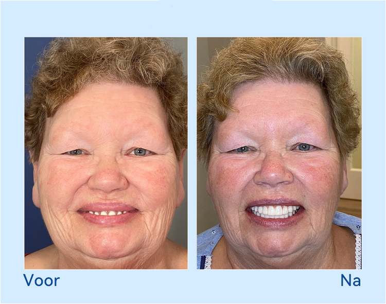 𝐇𝐢𝐝𝐨𝐧𝐞® --🦷𝐆𝐞𝐚𝐯𝐚𝐧𝐜𝐞𝐞𝐫𝐝 𝐀𝐚𝐧𝐠𝐞𝐩𝐚𝐬𝐭 𝐕𝐨𝐥𝐥𝐞𝐝𝐢𝐠𝐞 𝐊𝐮𝐧𝐬𝐭𝐠𝐞𝐛𝐢𝐭𝐬𝐞𝐭🦷 (⏰Tijdelijke korting, laatste 30 minuten⏰)📗📗