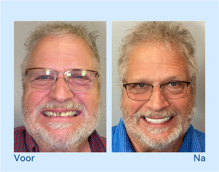 𝐇𝐢𝐝𝐨𝐧𝐞® --🦷𝐆𝐞𝐚𝐯𝐚𝐧𝐜𝐞𝐞𝐫𝐝 𝐀𝐚𝐧𝐠𝐞𝐩𝐚𝐬𝐭 𝐕𝐨𝐥𝐥𝐞𝐝𝐢𝐠𝐞 𝐊𝐮𝐧𝐬𝐭𝐠𝐞𝐛𝐢𝐭𝐬𝐞𝐭🦷 (⏰Tijdelijke korting, laatste 30 minuten⏰)📗📗